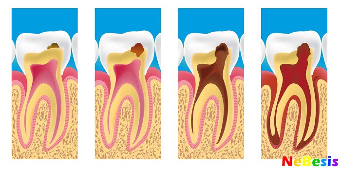 Лечение белых и черных пятен на зубах