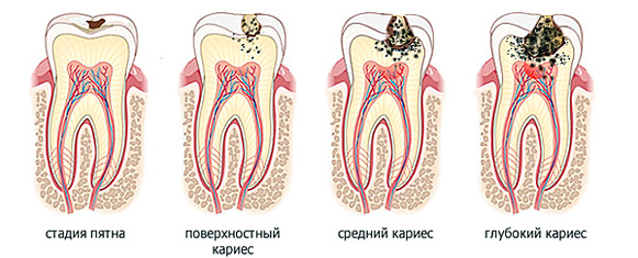 Черные точки и налет на зубах